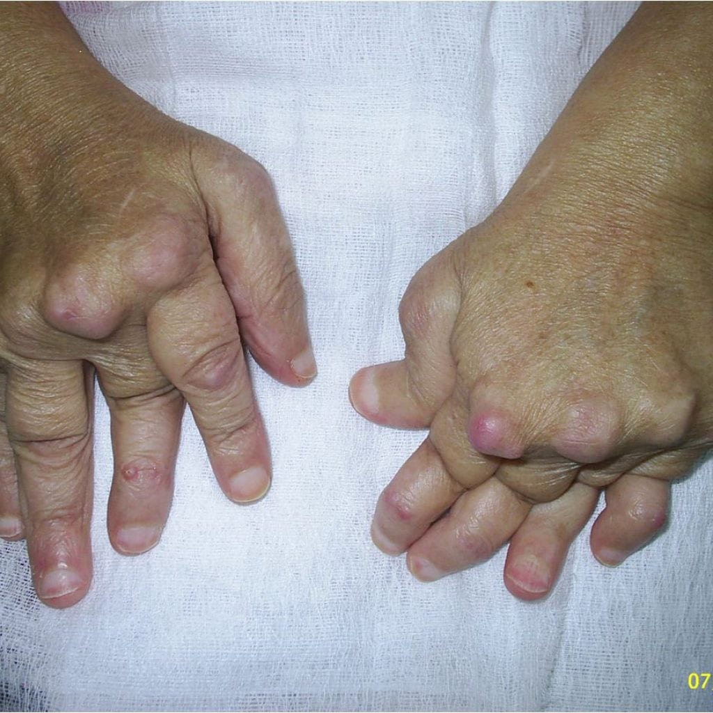Polyarthrite rhumatoïde: qu'est-ce que c'est, symptômes, comment traiter, photo