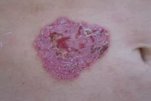 Karcinom pločastih stanica kože