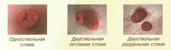 Stoma: what is it, grooming stoma