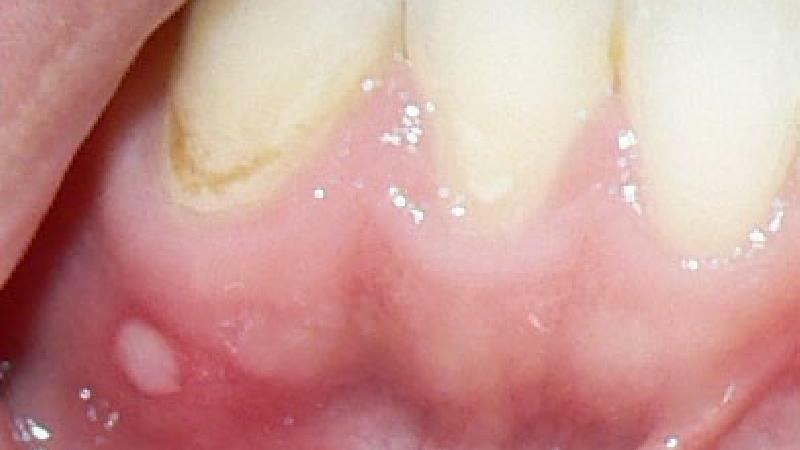 wie zur Behandlung von Krebs auf dem Zahnfleisch Foto