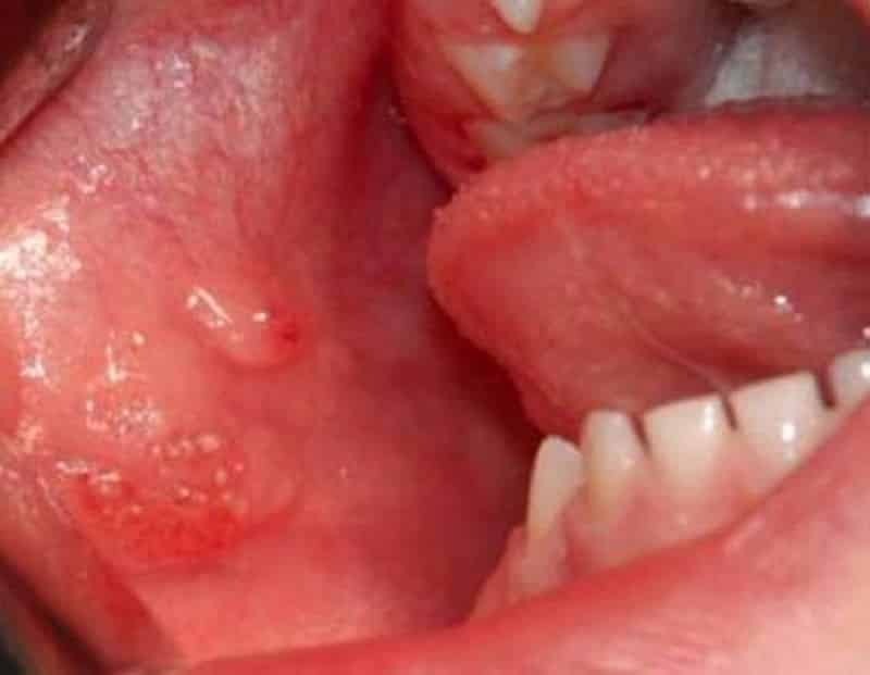 burbuja líquida transparente en la mucosa de la boca