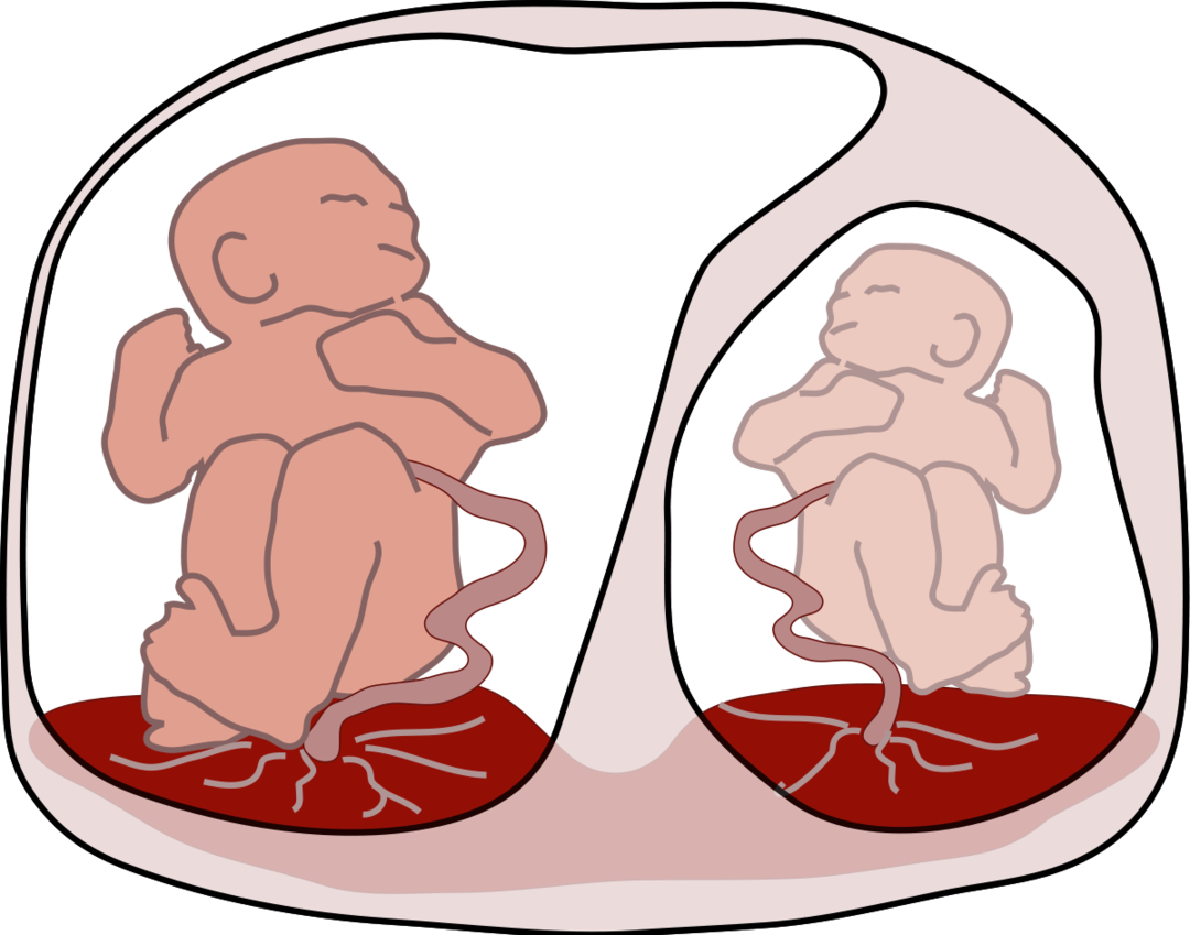Sindrome da trasfusione feto-fetale: che cos'è, cause, sintomi, trattamento, prognosi