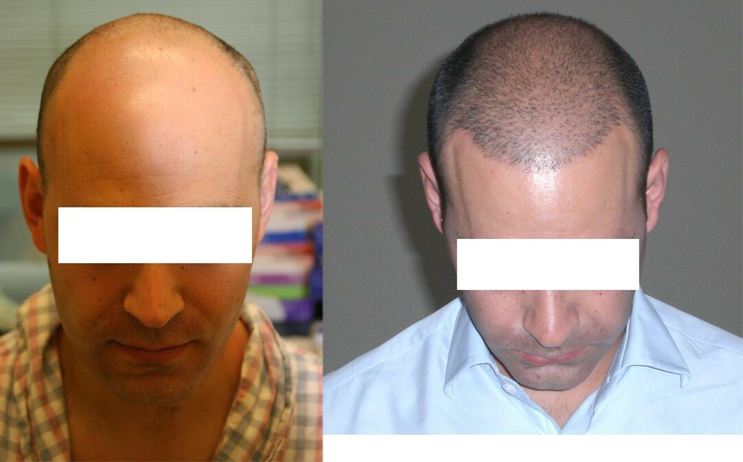 Behandling av alopeci hos kvinnor och män
