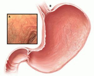 Type a, b en c gastritis: hoofdoorzaken, symptomen en verschil in behandelmethoden