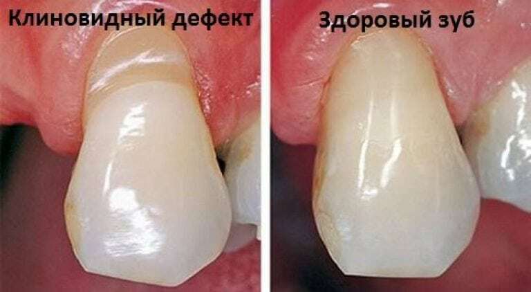 A fogak ék alakú hibája: mi ez, okok, tünetek, kezelés, megelőzés