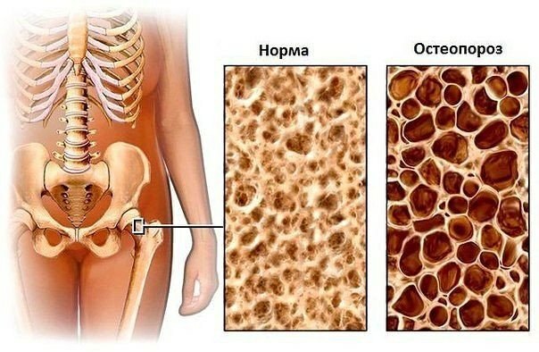 Las causas de la osteoporosis