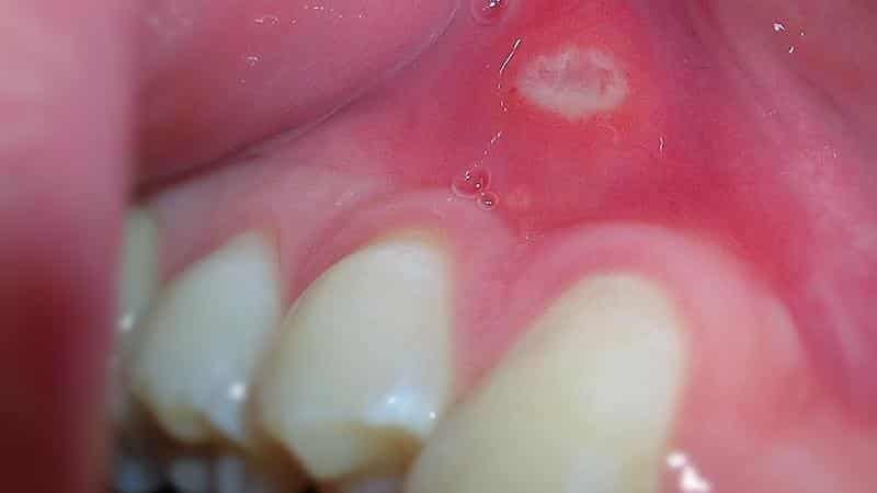 Weiß Pickel auf dem Zahnfleisch des Kindes und Erwachsenen - Ursachen und Behandlung