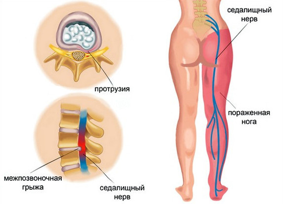 Pinched sciatic nerve: causes, symptoms, treatment, how to quickly relieve pain