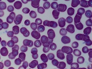 What is Babesiosis
