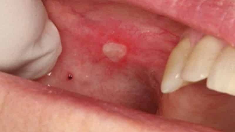 ulcere u ustima simptomi stomatitis