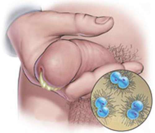 What are the secretions with prostatitis?
