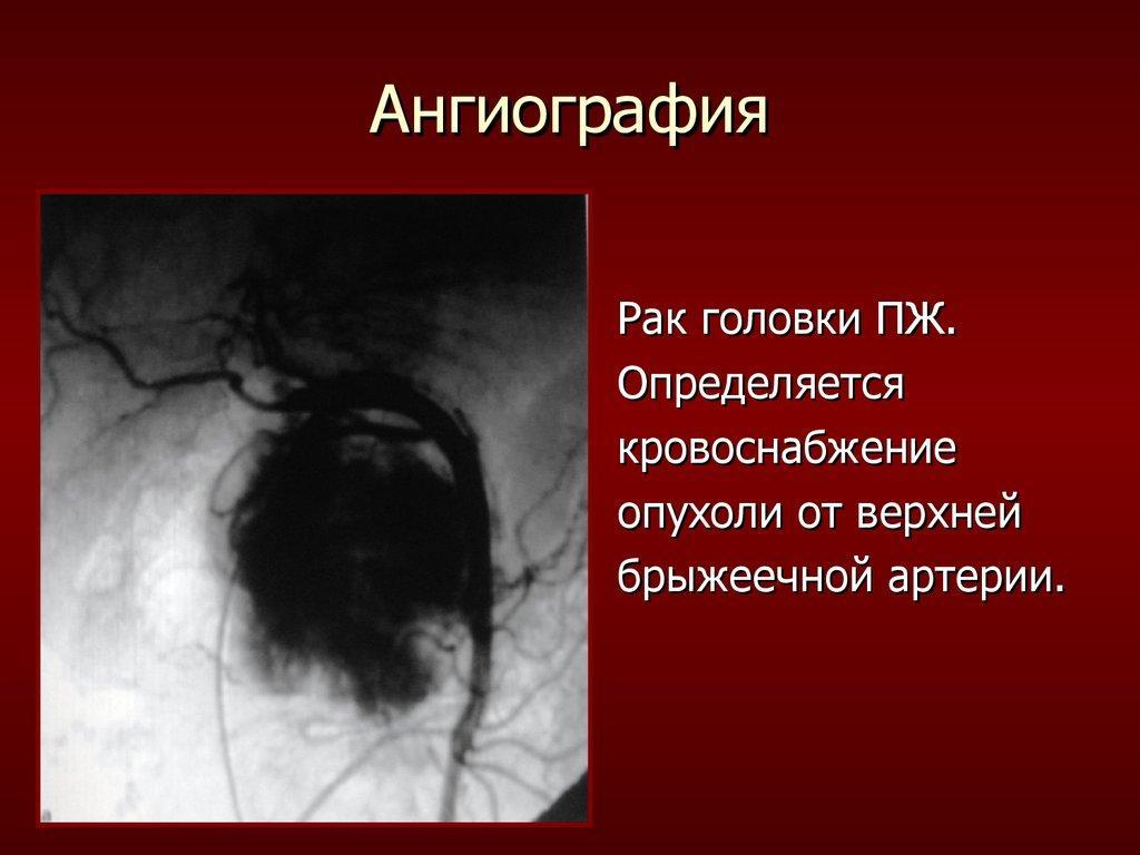 Angiografia. Câncer de cabeça do pâncreas