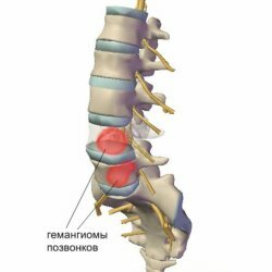 Hemangiomas of the vertebrae