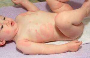 Allergie bei Säuglingen