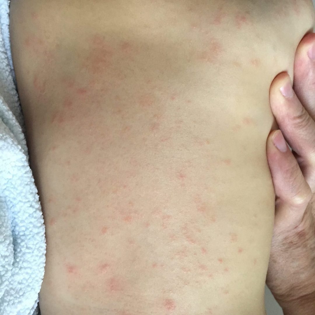 Alergia ao pó: causas, sintomas, tratamento para crianças, adultos