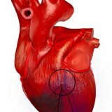 Causes and stages of myocardial infarction