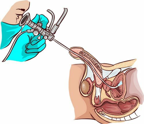 Features of the urethroscopy in men