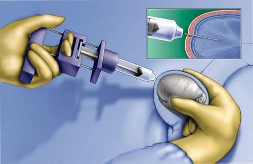 Testicular biopsy procedure