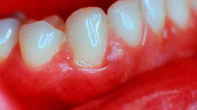 Gum sygdom og deres behandling, foto, symptomer