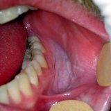 Behandeling van leukoplakia van de mondholte