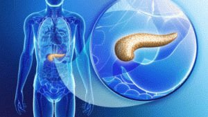 Pancreatitis - ICD-10-code voor chronische, acute en alcoholische aandoeningen