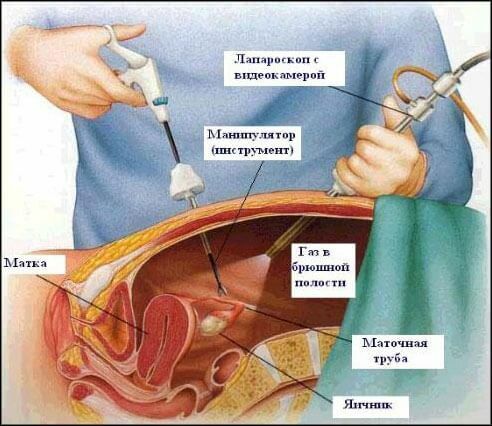 Laparoscopy: what is it, the pros and cons of laparoscopy of the abdominal organs