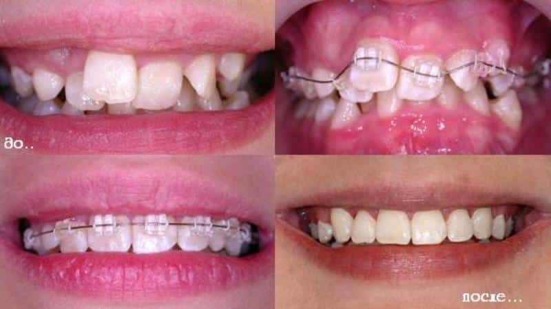 Zahnklammern vor und nach Fotos