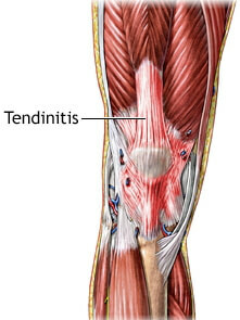 Foto af tendinitis