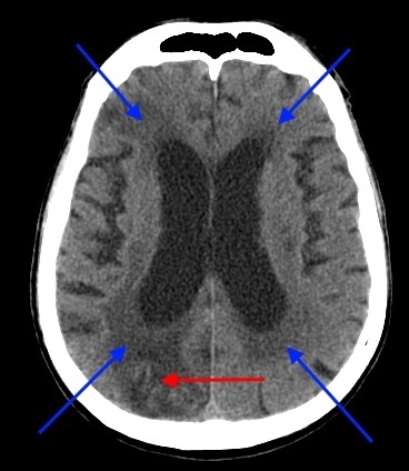 CT scan po świeżym udarze mózgu