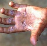 Symptoms, a disease of leprosy