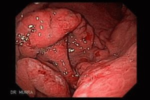 Haiguse gastriit