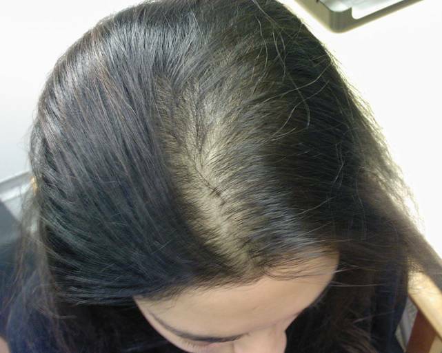 Telogen hair loss