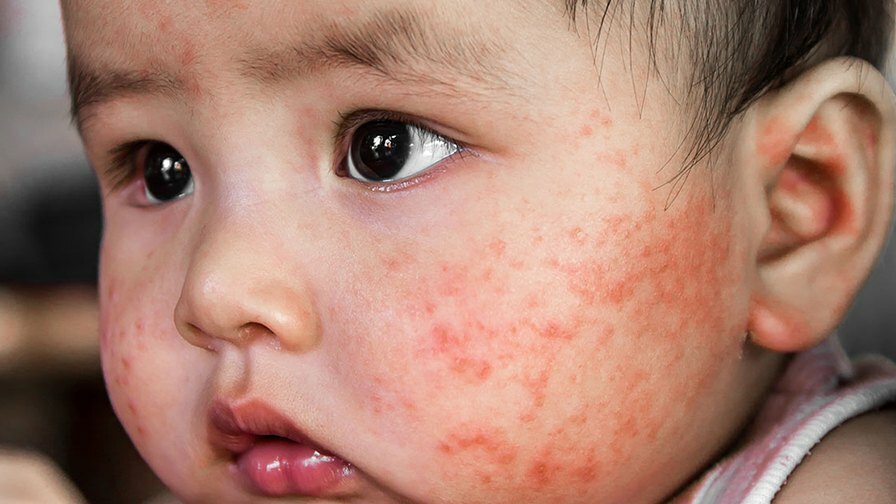 Dermatite atópica em crianças: sintomas (foto), tratamento, medicamentos
