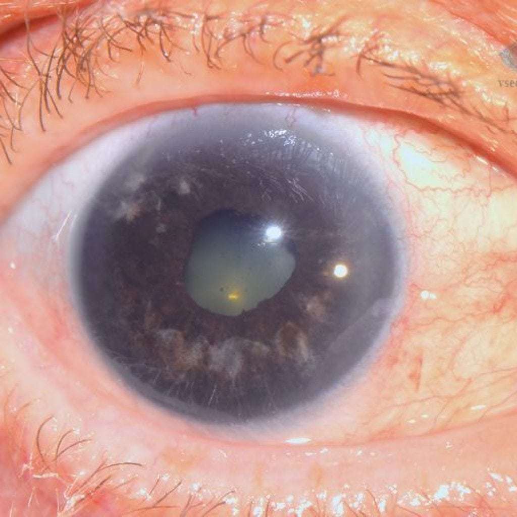Glaukom: uzroci, simptomi, liječenje i prevencija, prognoza