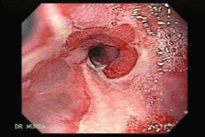 Peptische oesofagitis: graden, oorzaken, symptomen en behandeling