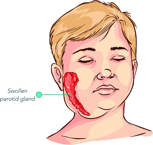 Mumpsa: simptomi in zdravljenje bolezni