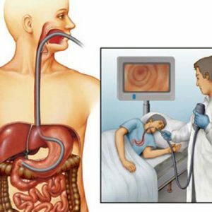 Endoskopii przewodu pokarmowego: esophagoscopy, gastroskopii duodenoscopy, endoskopia jelita