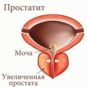 Prostatite por Clostridium