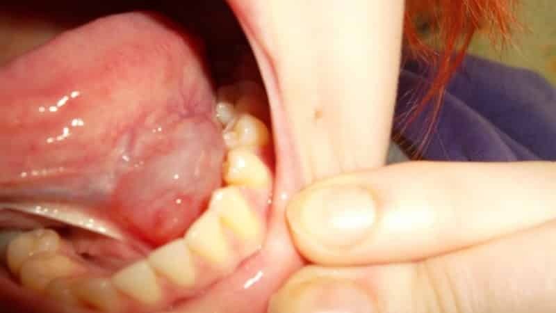 Perché ferire il frenulo sotto la lingua