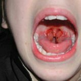 Liečba laryngotracheitídy u detí s ľudskými prostriedkami