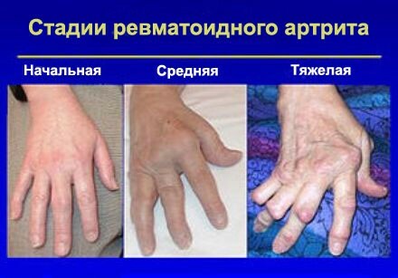 stupanj-reumatoidni artritis prsta ruke