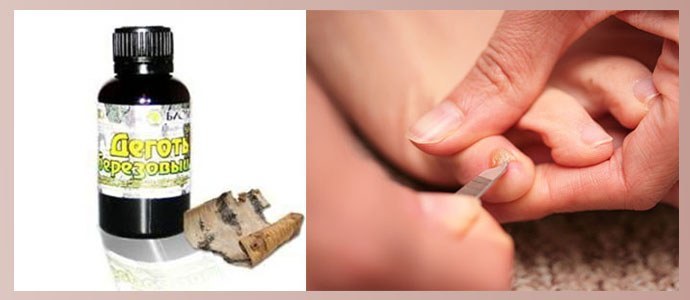 Tratamiento de hongos en las uñas con alquitrán de abedul.
