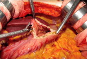 Longitudinale maagchirurgie