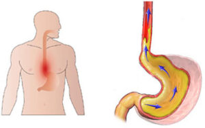 Feeling of heartburn