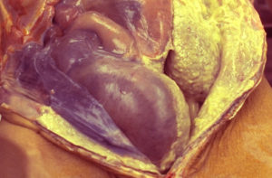 Purulente peritonitis