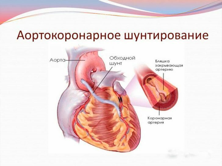 presađivanja premosnice koronarnih arterija