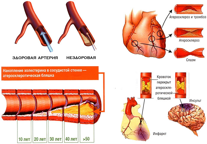 Ateroskleróza a ischemická choroba srdca