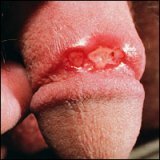 Genital Herpes: Symptoms of Treatment