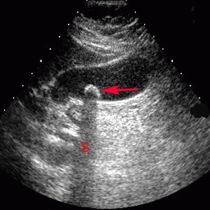Echografie van de galblaas