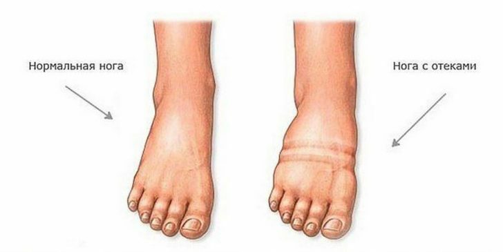 Swelling of the feet during pregnancy: causes, treatment and prevention